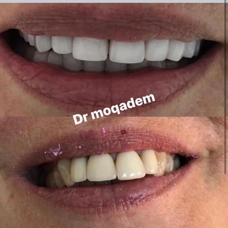 Facettes dentaires à Marrakech et au Maroc, Meilleur dentiste et clinique  dentaire à Marrakech et au Maroc